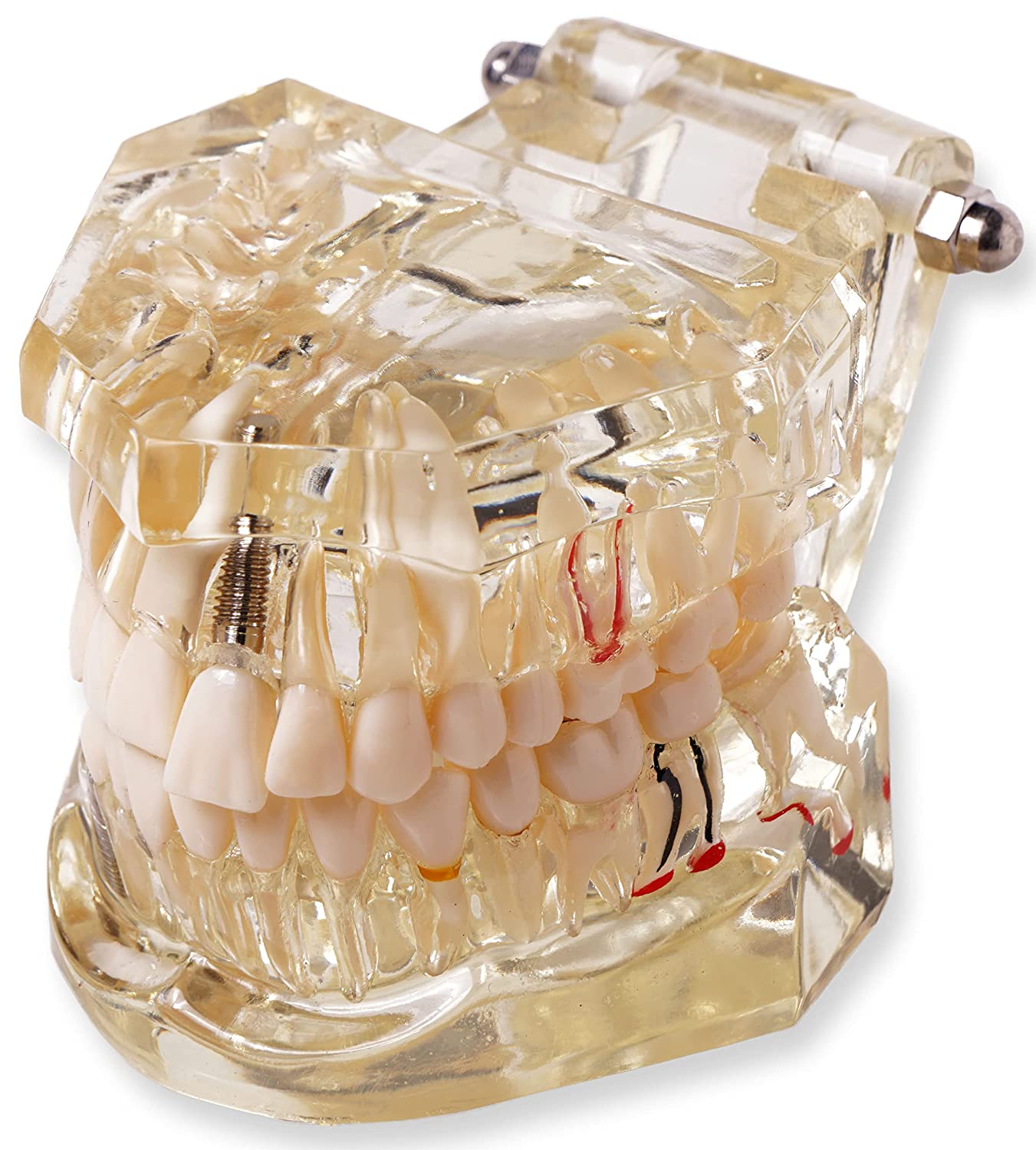 Teeth Model Dental Implant Restoration Model Typodont Transparent Removable Tooth Disease